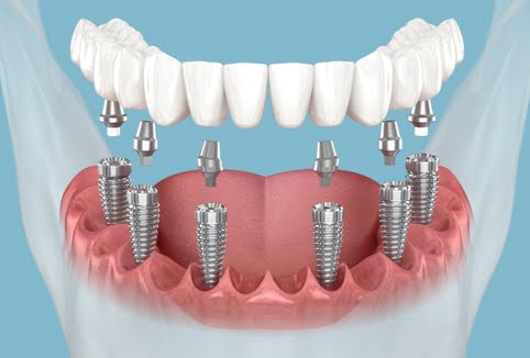 Dental Implants Treatment